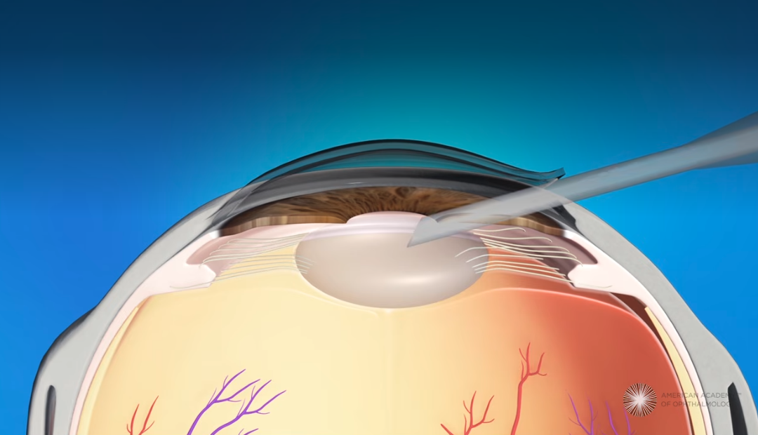 Phacoemulsification Cataract Surgery