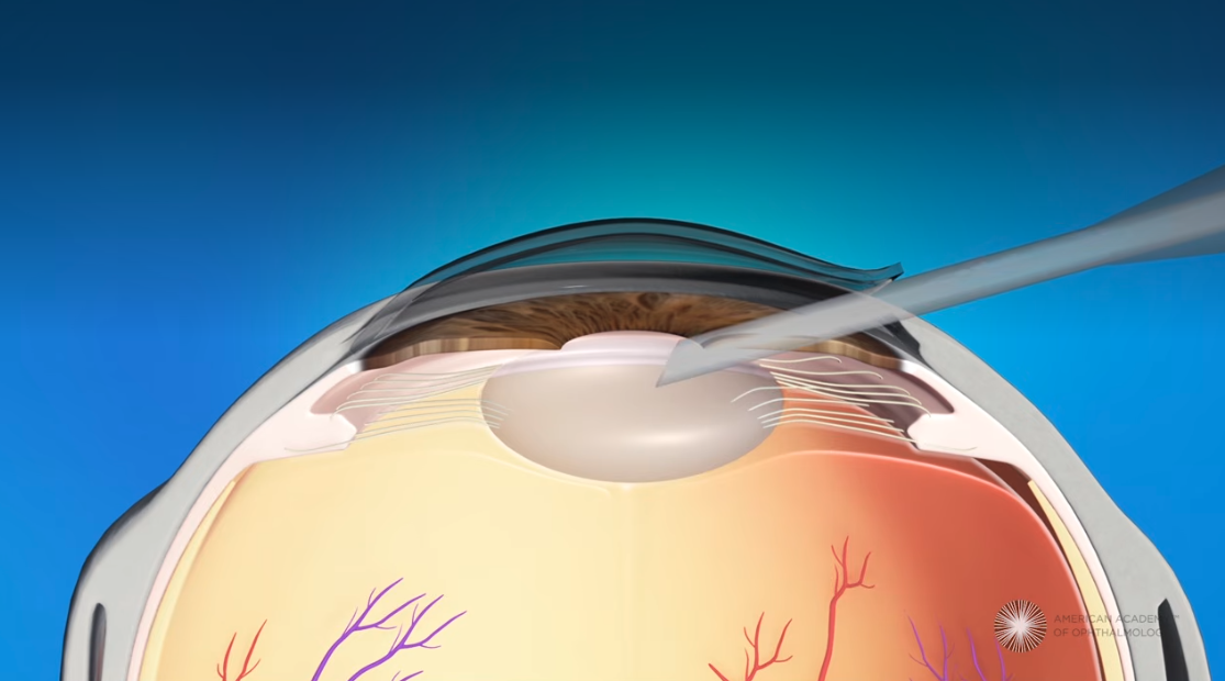 Phacoemulsification Cataract Surgery